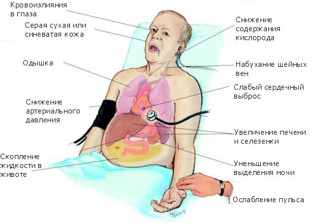 Симптомы недостаточности кровообращения