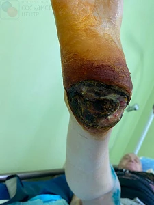 Лечение гангрены пятки с помощью лоскута