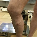 Лазерное лечение варикоза и флебэктомия с отдаленным результатом