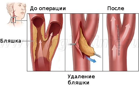 Каротидная эндартерэктомия